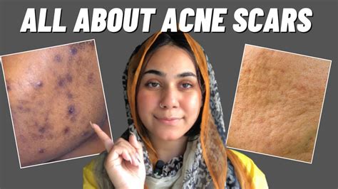 All About Acne Scars Types Of Acne Scars And Treatment Acne Acnescars
