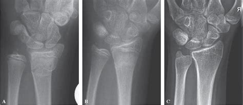 Figure 1 From Fracture Of The Ulnar Styloid Process Negatively