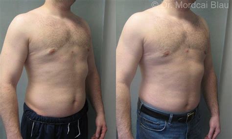 Gynecomastia Revision Surgery Of Other Surgeons Work Before And