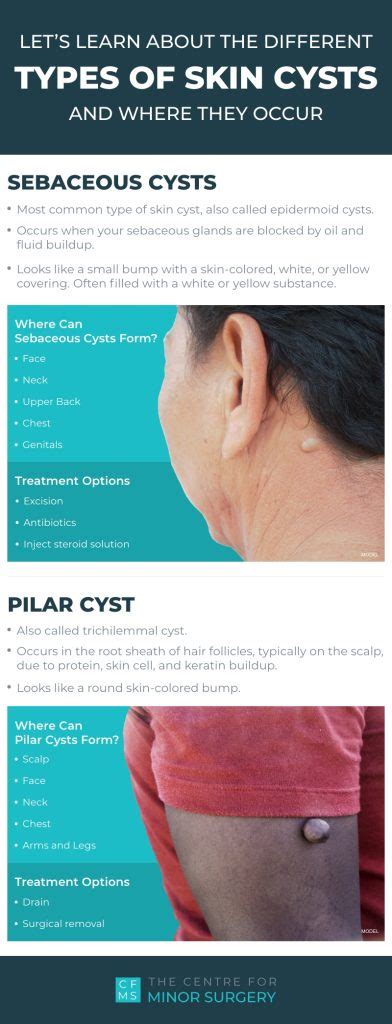 What Are The Different Types Of Skin Cysts Where Do They Occur Infographic Centre For