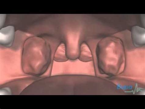 Adenoid And Tonsil Removal Youtube