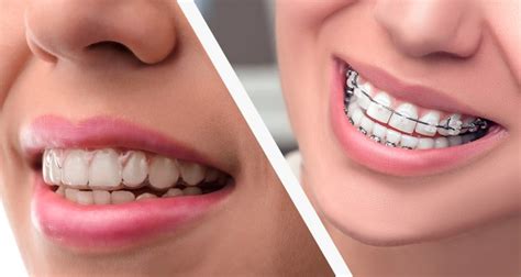 Cost Difference Between Braces And Invisalign Dentist Canberra
