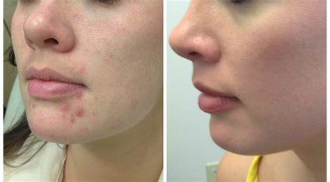 Is It Safe To Use Accutane For Acne