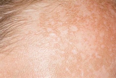 Macchie Scure Sulla Pelle Cinque Cose Da Sapere Sul Melasma