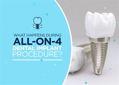 All On Dental Implant Procedure Explained