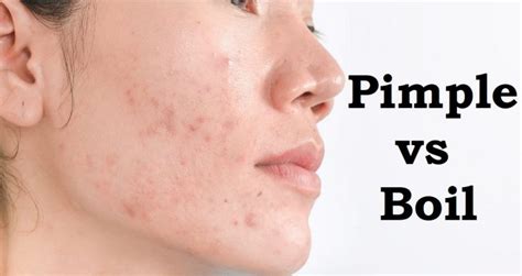 Pimple Vs Boil The Difference You Need To Know Health Argue