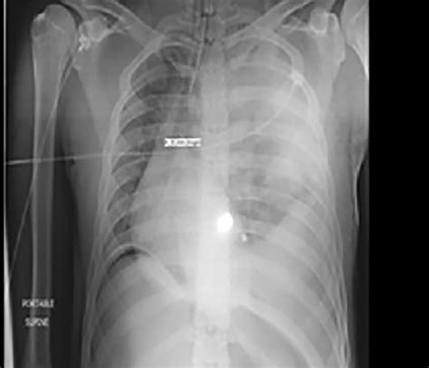 The Figure Is A Chest X Ray Demonstrating A Ballistic Injury To The
