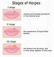 Living with Herpes | causes, symptoms, how to deal with herpes?