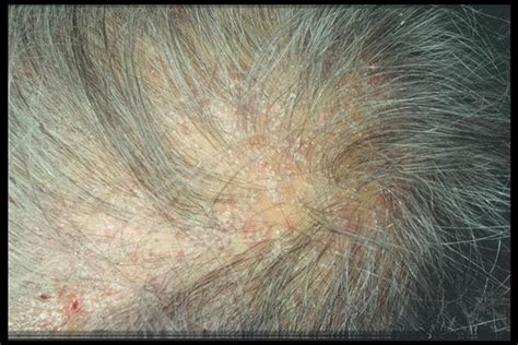 Superficial Fungal Infections Tinea Capitis In An Adult Picture