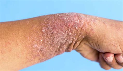 Dermatitis Atópica Severa ~ Psoriasis