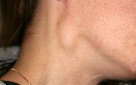 The lumps themselves are swollen lymph nodes, and they typically appear in the neck, armpit, or groin. Swollen Lymph Nodes In Neck One Side | Children Or Adults