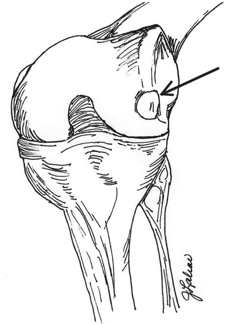 Osteochondral Injury To The Mid Lateral Weight Bearing Portion Of The Lateral Femoral Condyle