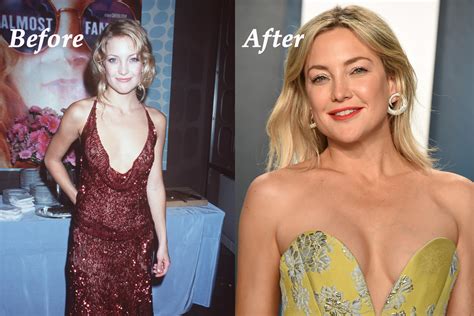 Kate Hudson Boob Job Before And After Pictures Plastic Surgery Magazine