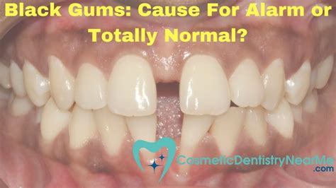 Black Gums Sign Of A Problem Or Completely Normal Dentists Columbus Oh