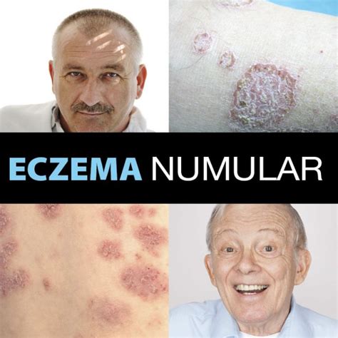 Eczema Numular Causas Síntomas Diagnóstico Y Tratamiento La Guía