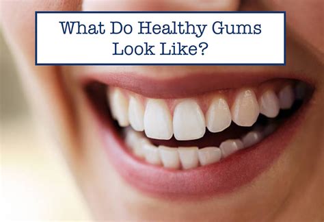 What Do Healthy Gums Look Like