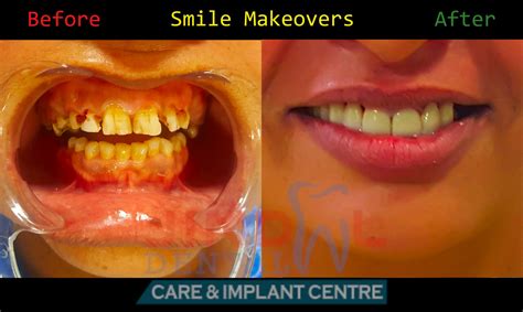 Gallery Jindal Dental Care And Implant Centre