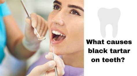 Black Tartar On Teeth Causes Symptoms Treatments 2024