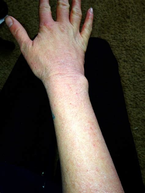 Scratching The Surface Of Topical Steroid Withdrawal 75 Months Dead