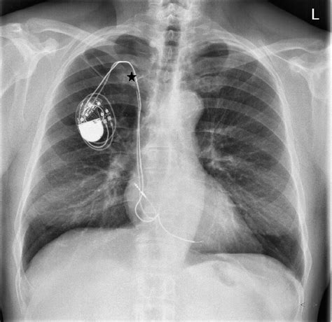 A Preoperative Chest X Ray Showing Two Pacemaker Leads Implanted Via A