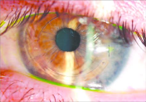 Intra Corneal Rings On Another Patient With Keratoconus Download