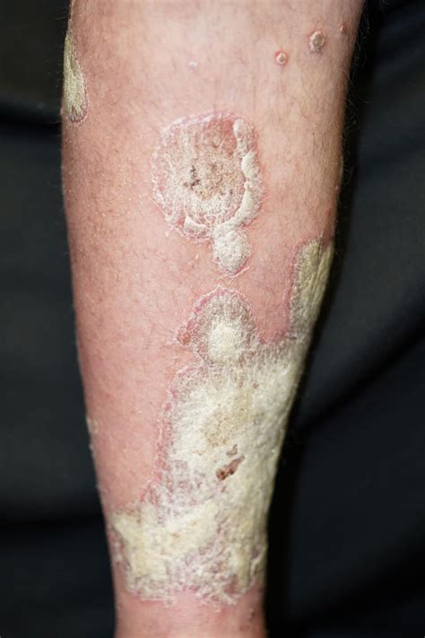 Biologic Drug Therapy In Severe Plaque Psoriasis With New Onset Joint