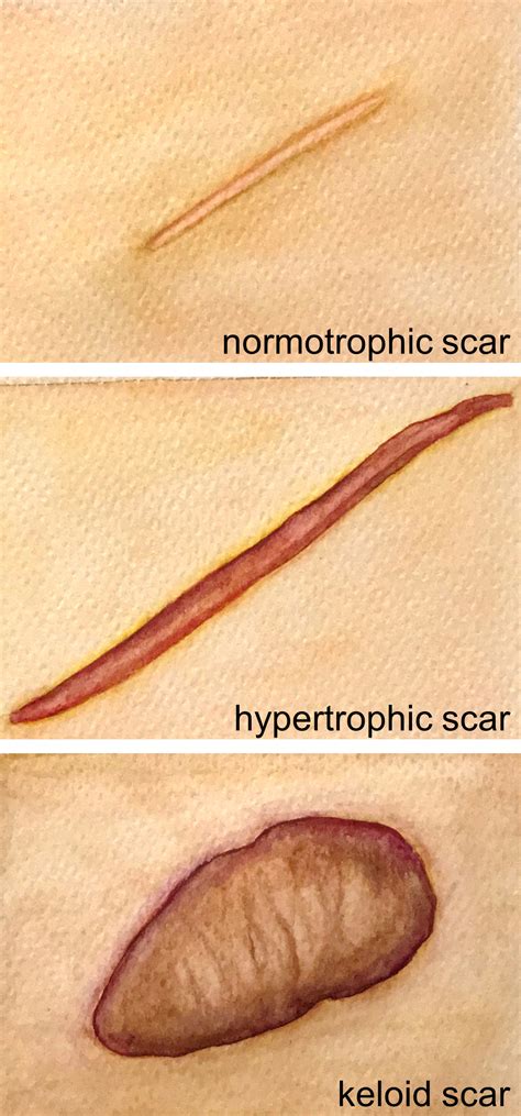 Hypertrophic Scars And Keloids Overview Of The Evidence And Practical Guide For Differentiating
