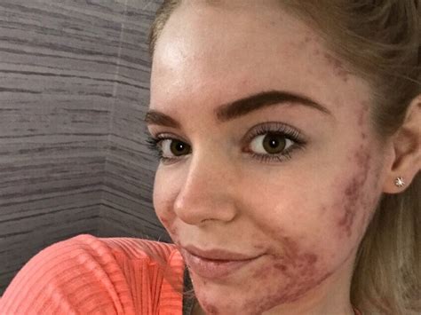 This Beauty Pageant Contestants Acne Kept Her From