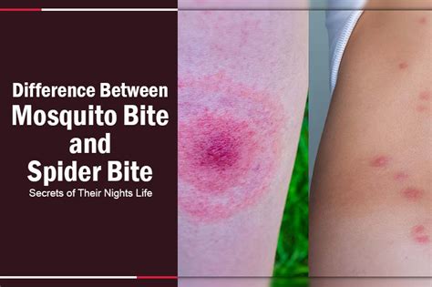 Difference Between Mosquito Bite And Spider Bite Quick Guide