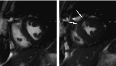 Short Axis Cine Magnetic Resonance Images Ssfp Sequence At Rest At