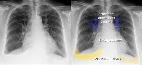 Pleural Effusion Vs Normal Chest X Ray Porn Sex Picture