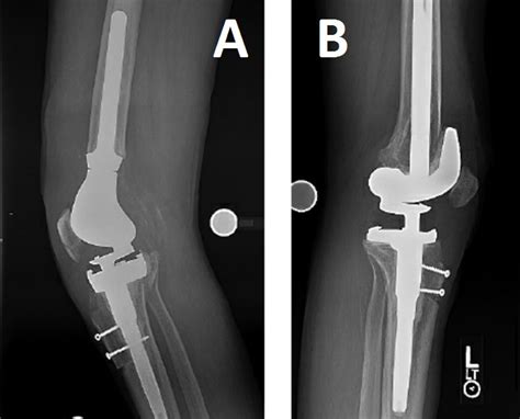 Chronic Extensor Mechanism Disruption After Tka Hss Case