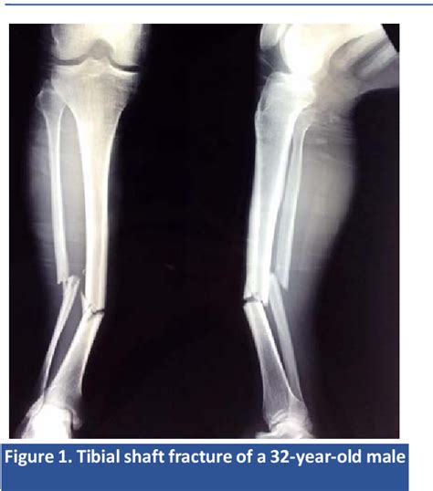 Figure 1 From Outcome Of Tibial Diaphyseal Fracture Fixation With