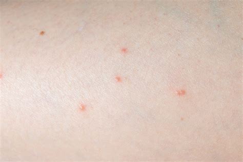 What Spider Bites Look Like—and When To Call The Doctor Rdca