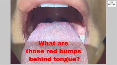 Bumps On Back Of Tongue And Throat