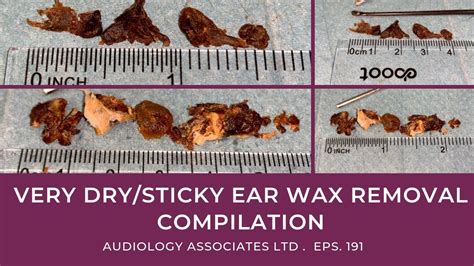 Very Drysticky Ear Wax Removal Compilation Ep 191 Youtube