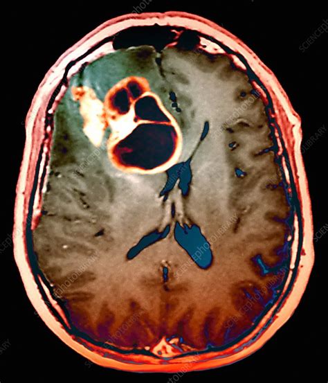 Brain Cancer Mri Scan Stock Image M1340470 Science Photo Library