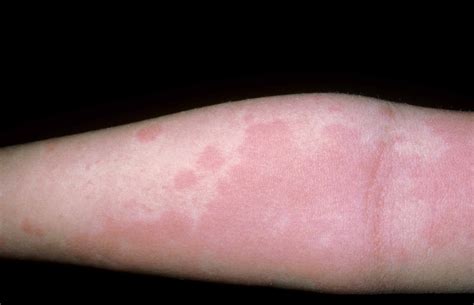 Urticaria Rash On Arm Food Allergy Symptoms Common Food Allergies