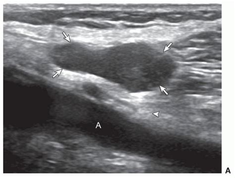 Liposarcoma Low Grade Myxoid Recurrent Ultrasound Image A Shows