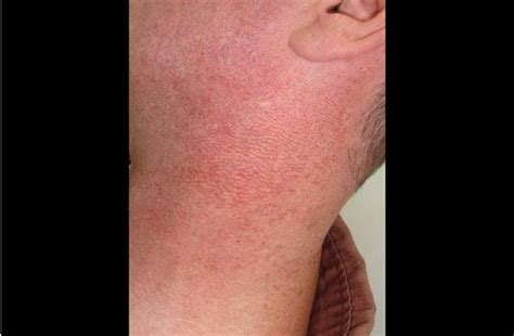 Clinical Challenge A Rash That Doesnt Respond To Steroids Mpr