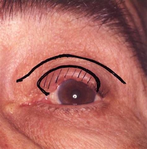 Basal Cell Carcinoma Of The Superior Eyelid Margin Download