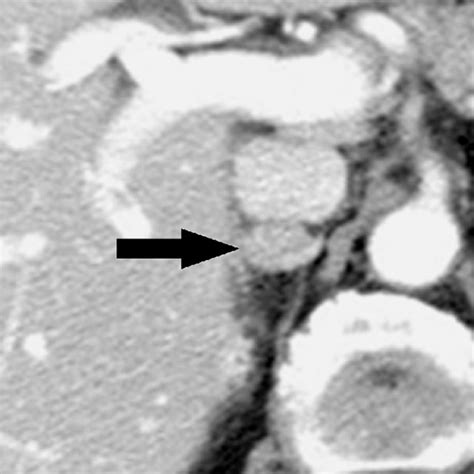Axial Contrast Enhanced Portal Venous Phase Ct Scan In A 76 Year Old