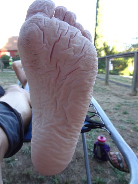 Maceration Of The Feet Part 1 — Blister Prevention
