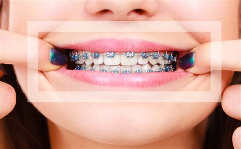 Good Colors To Use For Braces Warehouse Of Ideas