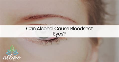 Can Alcohol Cause Bloodshot Eyes Allure Detox
