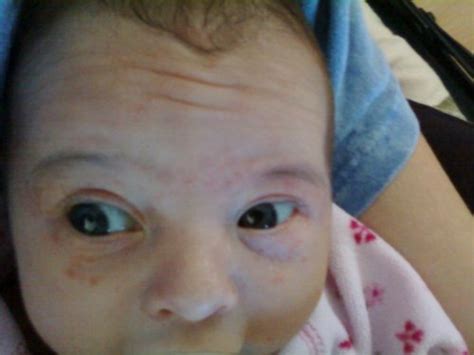 Lots Of Red Bumps On Babys Face Normal Pics Babycenter