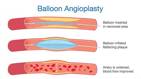 What Is Balloon Angioplasty Kossel Medtech