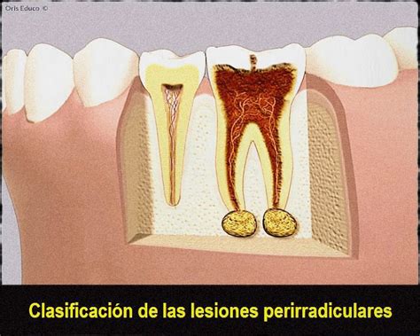 Periodoncia Clasificación De Las Lesiones Perirradiculares