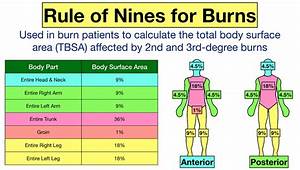 Rule Of Nines For Burns Child And Chart Calculator Definition