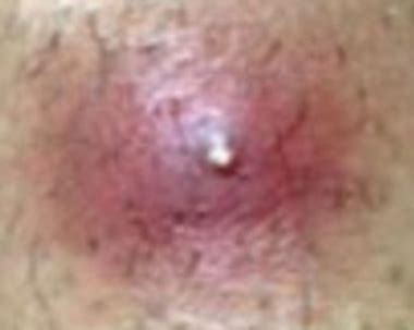 Ingrown hairs can happen anywhere hair grows on the body. Infected Ingrown Hair: Symptoms, Causes, Pictures, Boils ...